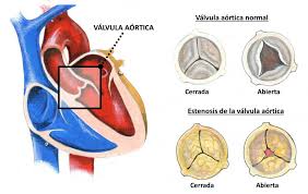 Medicamento para diabetes reduce riesgo de muerte