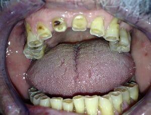 Estomatólogo cubano crea nuevo algoritmo médico para el tratamiento del bruxismo y su riesgo cardiovascular