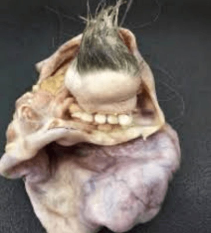 El tumor que parece tener vida
