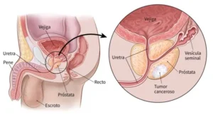 Frena Cáncer de próstata