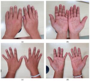 Dolor Articular por Chikungunya: Cuidados Esenciales para Aliviarlo