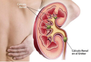 Innovadora tecnología con microrrobots promete disolver cálculos renales en días.